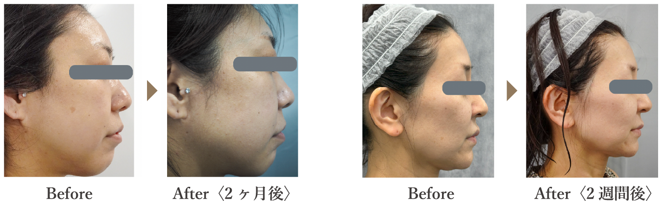 before after