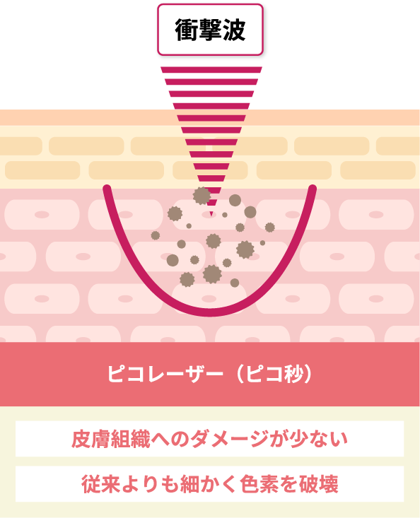 皮膚組織へのダメージが少ない従来よりも細かく色素を破壊