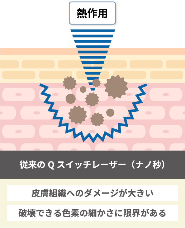 皮膚組織へのダメージが大きい破壊できる色素の細かさに限界がある
