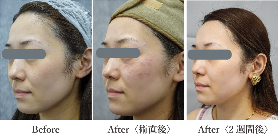 before after